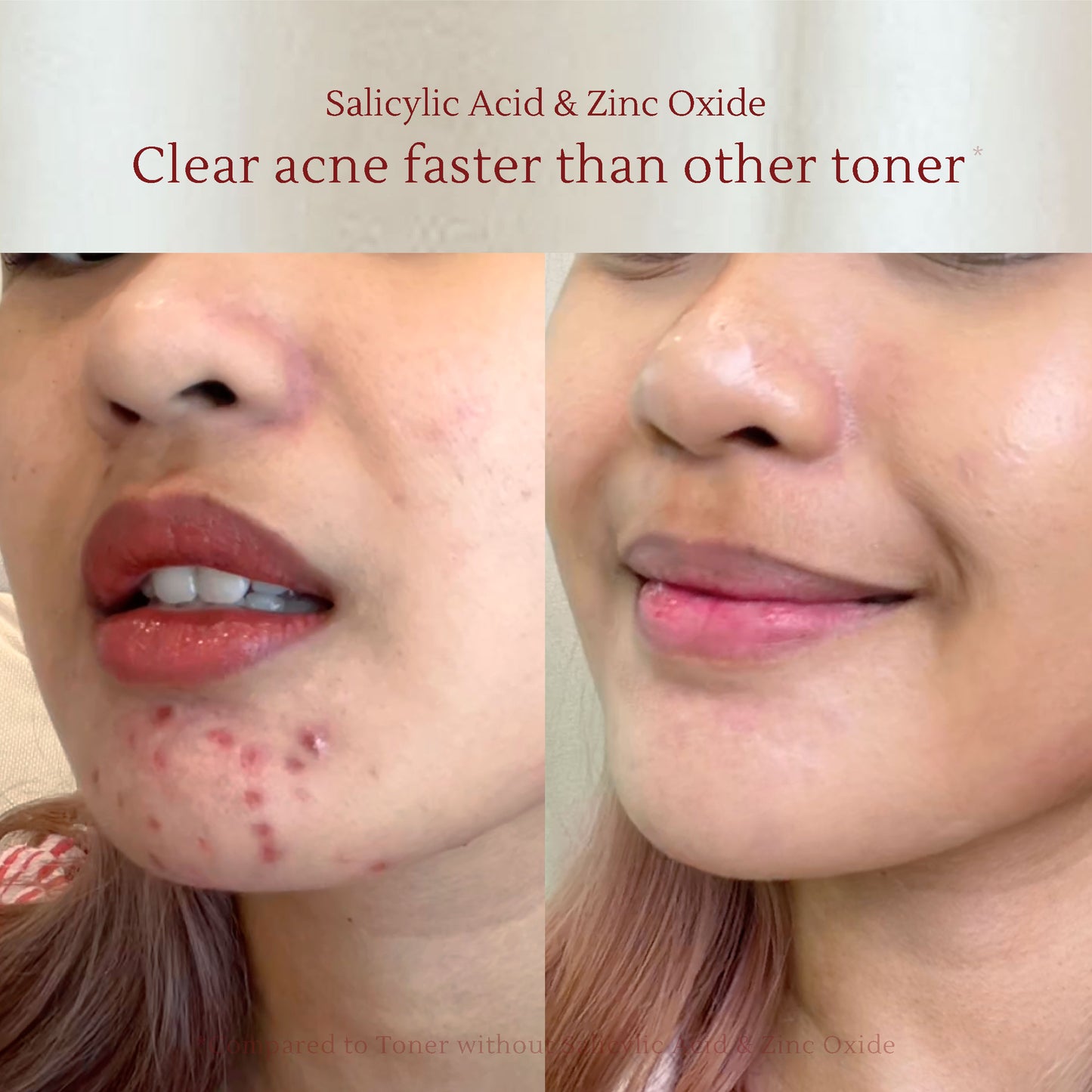 Salicylic Toner 120ml Dark Spots & Acne Gone in 14 Days, Fade PIE & PIH Acne Scars, Disguise Black Spots & Melasma, Brighten Dull Skin, Moisturize Skin