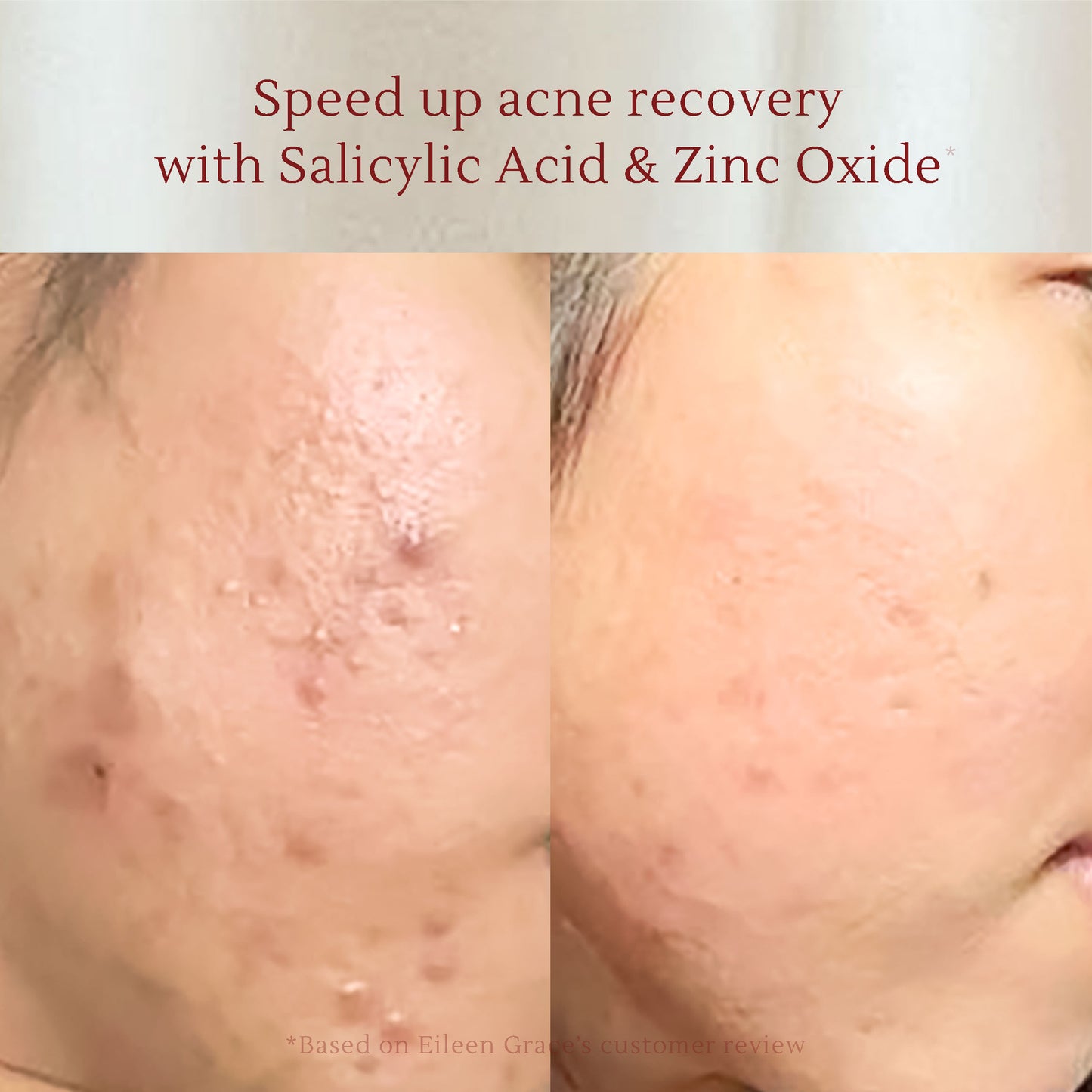 Salicylic Toner 120ml Dark Spots & Acne Gone in 14 Days, Fade PIE & PIH Acne Scars, Disguise Black Spots & Melasma, Brighten Dull Skin, Moisturize Skin