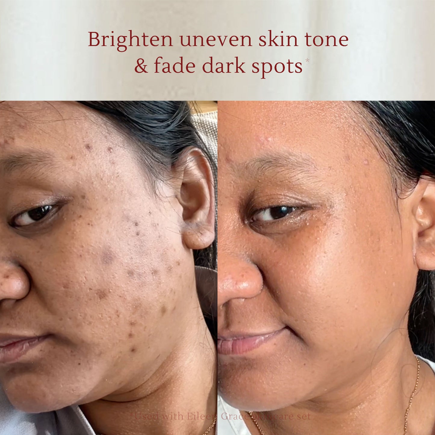 Salicylic Toner 120ml Dark Spots & Acne Gone in 14 Days, Fade PIE & PIH Acne Scars, Disguise Black Spots & Melasma, Brighten Dull Skin, Moisturize Skin