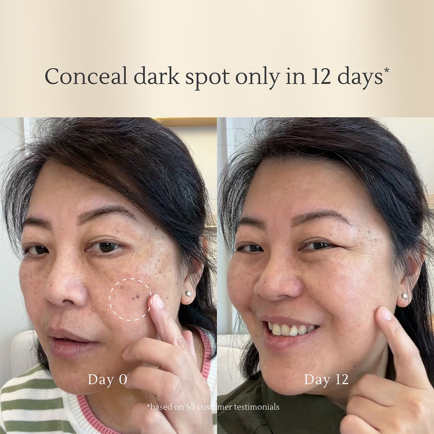 Micrite 3D All Use Dark Spot Correcting Serum Fade Dark Spots/Melasma, Removes Black Acne Scars, Brightens Skin, Production of Collagen